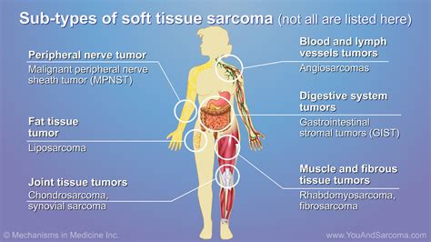 how to test for soft tissue sarcoma|soft tissue sarcoma in adults.